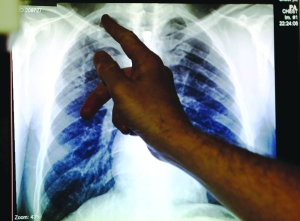 AI could help eliminate tuberculosis - Vimarsana News