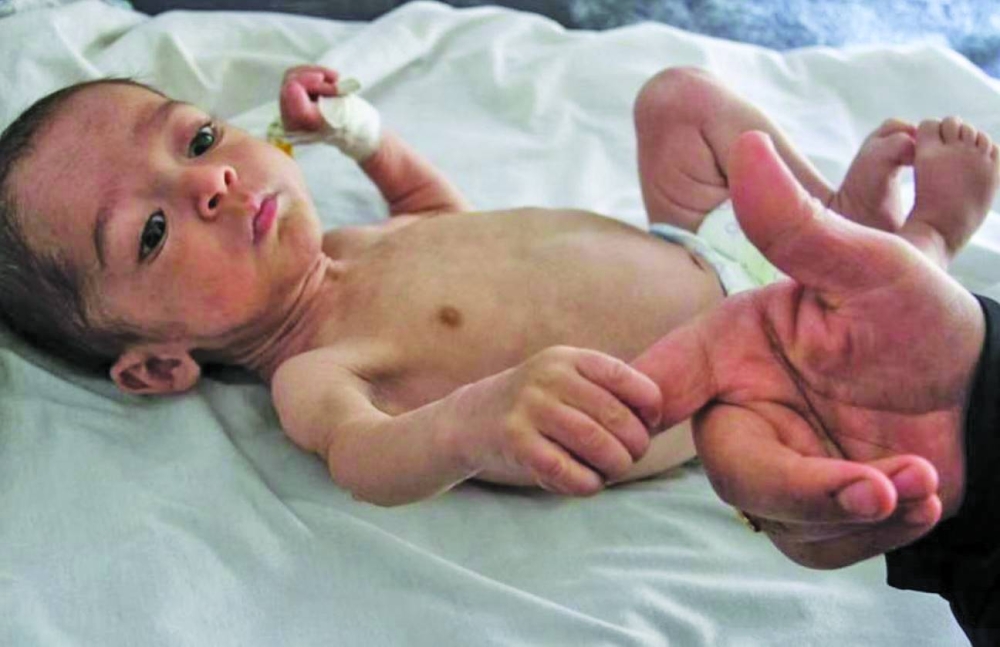 
Palestinian woman Nisreen holds the hand of her son Majd Salem, a six-month-old malnourished Palestinian baby who weighed 3.5kg when he was born and gained just 300 grams in six months, at Kamal Adwan hospital in the northern Gaza Strip on May 9. (Reuters) 