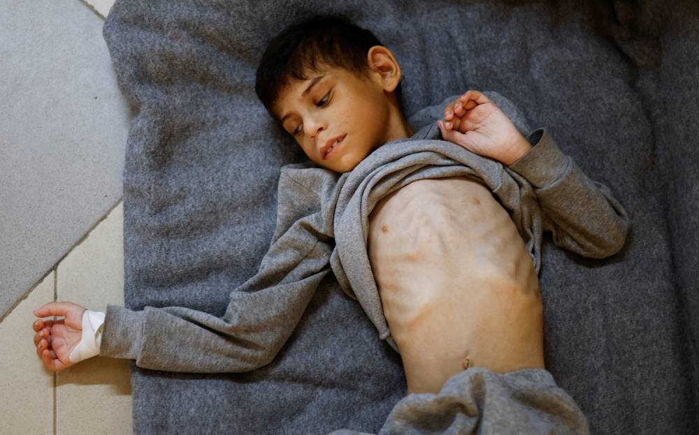 Palestinian boy Younis Joma lays at Nasser hospital in Khan Younis, in the southern Gaza Strip, Monday. REUTERS