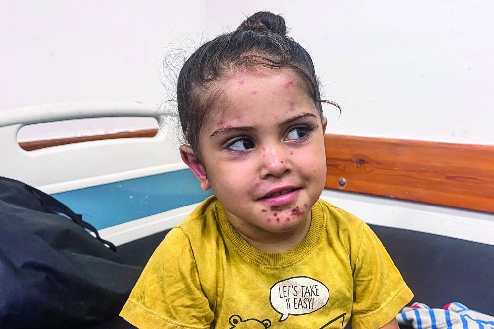 A Palestinian girl with a skin disease looks on as she receives treatment at Nasser hospital, amid Israel-Hamas conflict, in Khan Younis in the southern Gaza Strip July 29, 2024. REUTERS/Hussam Al-Masri
