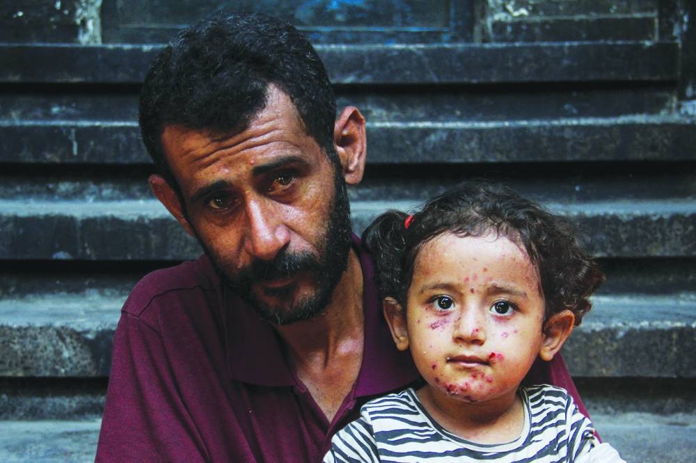 Yasmine al-Shanbari, a Palestinian girl with a skin infection, looks on as she is held by her father, amid Israel-Hamas conflict, in Jabalia in the northern Gaza Strip.