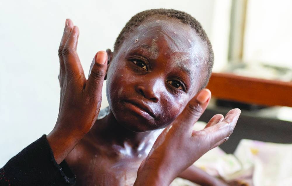 Medication being applied on the skin of Sagesse Hakizimana, who is under treatment against mpox, an infectious disease caused by the monkeypox virus that causes a painful rash, enlarged lymph nodes and fever, at a health centre in Munigi, Nyiragongo territory, near Goma in North Kivu province of the Democratic Republic of Congo. (Reuters)