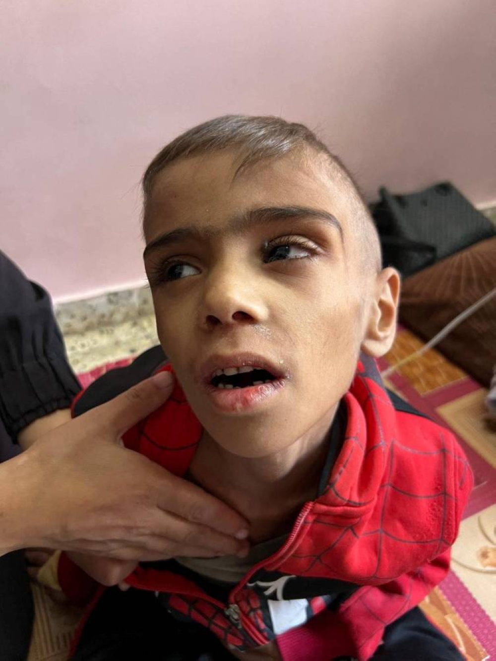 A malnourished Palestinian child examined by Gregory Shay, a retired pediatric pulmonologist, looks on in Khan Younis, southern Gaza Strip  in October, 2024. Gregory Shay/Handout via REUTERS
