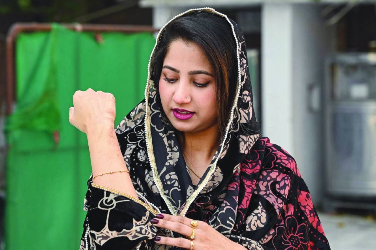 Natasha Zulfiqar shows the scars on her right hand during the interview. – AFP