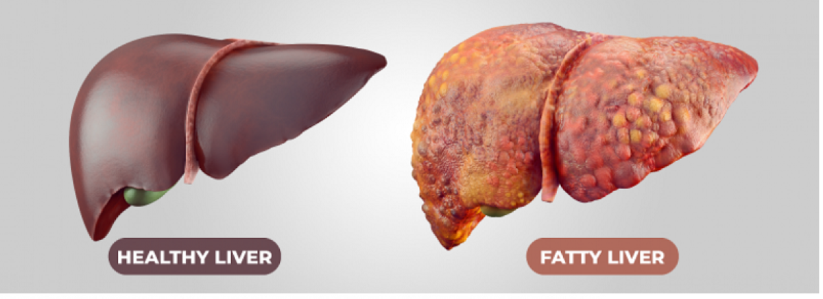 About 30% of people globally are affected by metabolic-associated fatty-liver.
