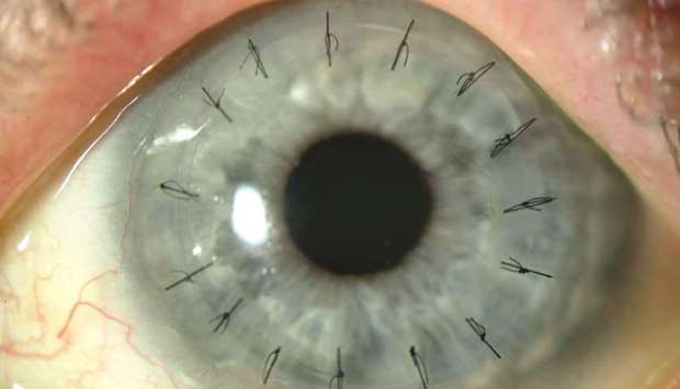 IMPROVED: Currently, corneal donor tissue older than seven days are not used for transplant.