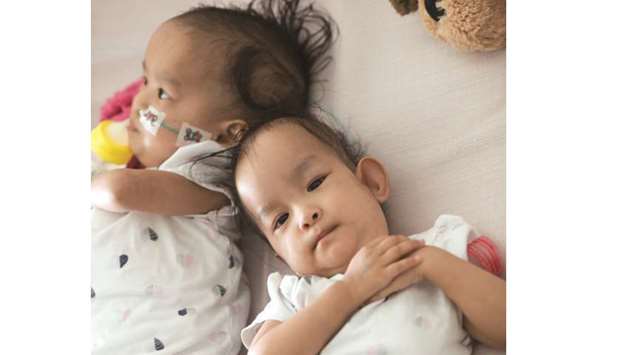 Bhutanese twins Dawa and Nima nearly a week after the successful surgery to separate them at Melbourneu2019s Royal Childrenu2019s Hospital (RCH).