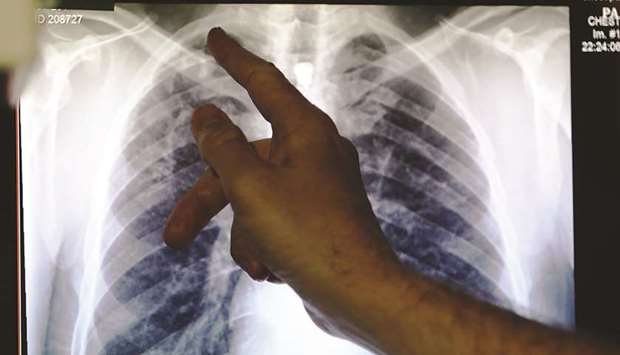 A doctor points to an X-ray showing lungs.