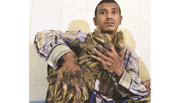 Abul Bajandar, 26, dubbed u201cTree Manu201d for massive bark-like warts on his hands and feet, sits at Dhaka Medical College Hospital in Dhaka yesterday.
