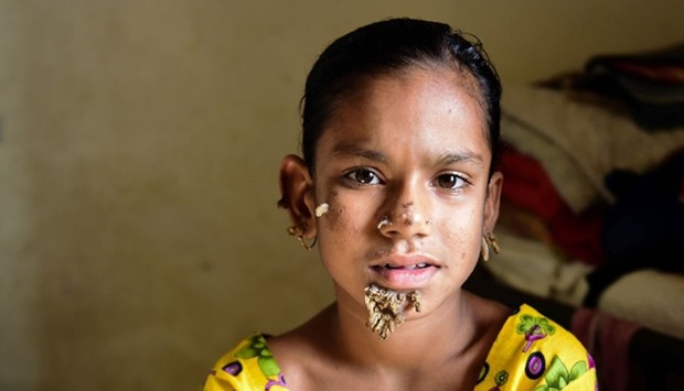 Sahana Khatun, 10, poses for a photograph at the Dhaka Medical College Hospital.