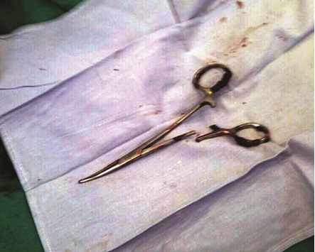 The scissors were removed after a three-hour operation.
