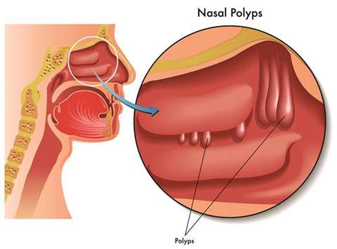 INDICATIONS: Small nasal polyps may not cause symptoms. Larger growths or groups of nasal polyps can block your nasal passages or lead to breathing problems, a lost sense of smell, and frequent infections.