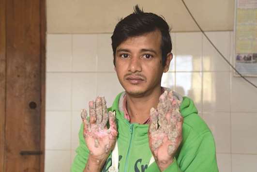 u201cTree Manu201d Abul Bajandar showing his palms where the warts are regrowing at Dhaka Medical College Hospital in Dhaka.
