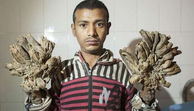 Bangladesh 'Tree Man' Abul Bajandar