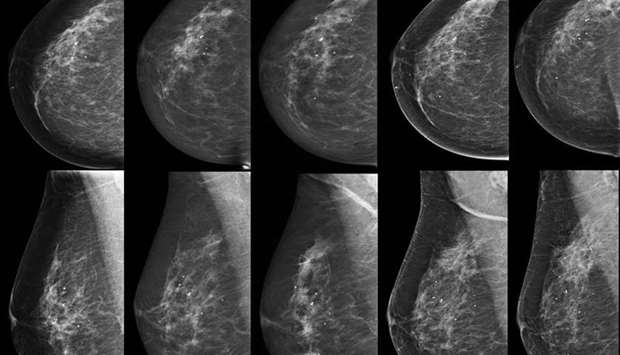 Interpreting the scans leaves room for error, and a small percentage of all mammograms either return a false positive