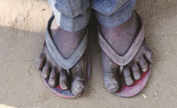 A boy shows his dry feet due to ash pollution caused by National Thermal Power Corporation coal plant of Dadri in Uncha Amipur village.
