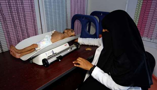 A nurse weighs one-year-old Fatima Abdullah Hassan, who suffers from severe malnutrition, at a malnutrition treatment center in the Red Sea port city of Hodeida, Yemen.