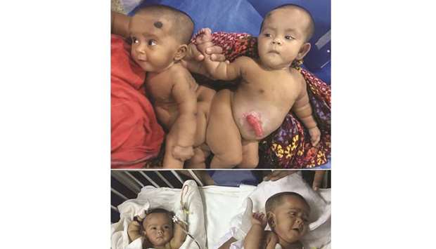 A file photo taken on August 2017 shows conjoined Bangladeshi twins Tofa and Tahura after surgery to separate them at Dhaka Medical College Hospital.