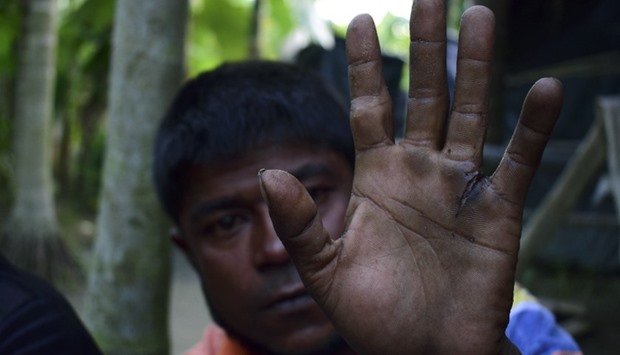 Rohingya refugee Mujibullah as he holds up his hand, which was hacked during a beating by soldiers who were attempting to rape his sister, as he sits at a makeshift refugee camp in Teknaf, in southern Cox's Bazar district. File photograph taken on November 24, 2016.