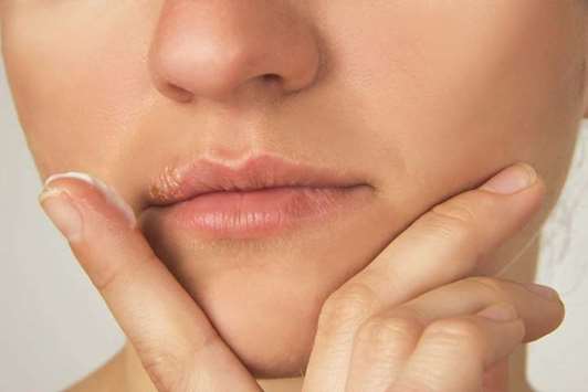 Cold sores, a common viral infection, are tiny, fluid-filled blisters on and around lips.