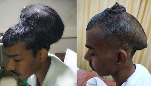 Santlal Pal before undergoing surgery to remove the brain tumour at Nair hospital in Mumbai.  (right) Santlal Pal after surgeons removed the brain tumour.
