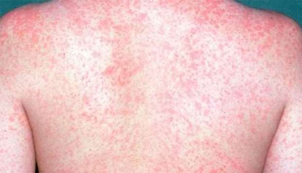 Samoa measles outbreak kills 20