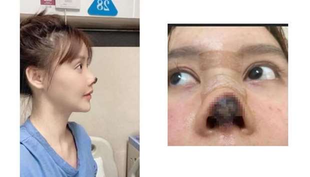 Chinese actress shares photos of her botched nose surgeryrnrn