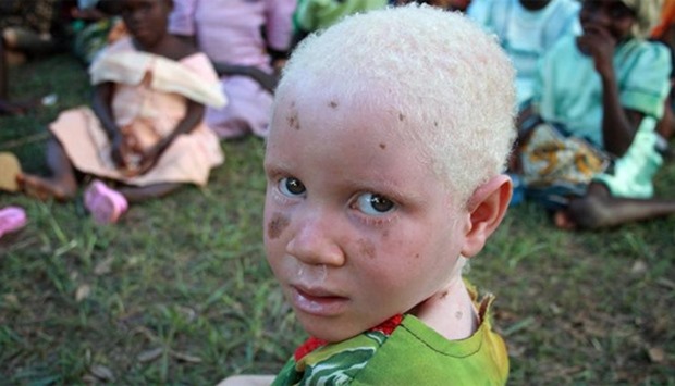 albino