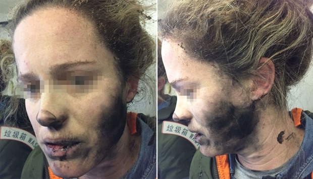 ATSB shows a woman after she suffered burns to her face and hands after her headphones caught fire