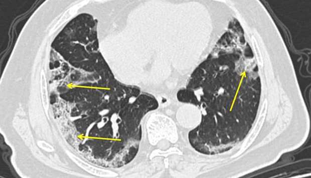 AFFECTED: This image shows a CT scan from a man with Covid-19. Pneumonia caused by the new coronavirus can show up as distinctive hazy patches on the outer edges of the lungs, indicated by arrows
