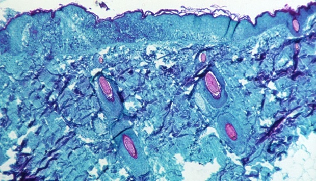 A section of skin tissue, harvested from a lesion on the skin of a monkey, that had been infected with monkeypox virus, is seen at 50X magnification on day four of rash development in 1968.