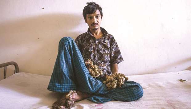 Abul Bajandar, dubbed u201cTree Manu201d for massive bark-like warts on his hands and feet, sits at Dhaka Medical College Hospital in Dhaka yesterday.