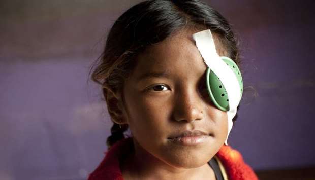Anisha Pun, 8, suffered a corneal rupture in her left eye in a trauma incident with a wire in her house.