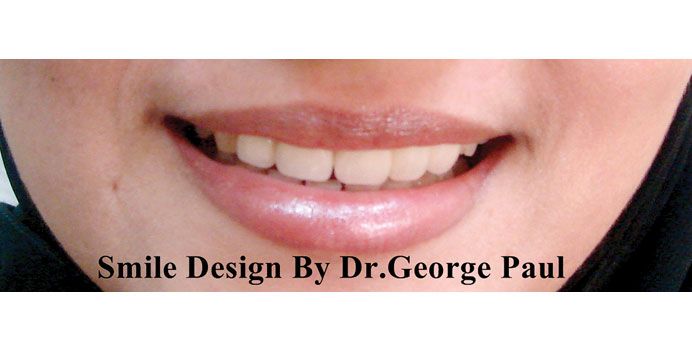 Smile designs by Dr George Paul