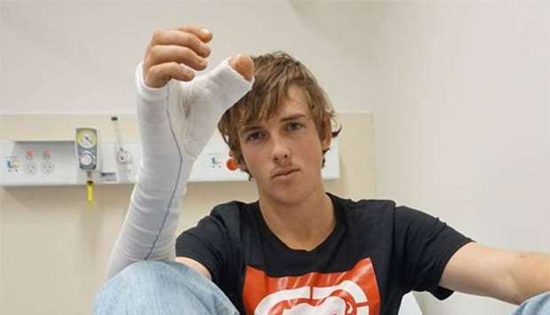 Zac Mitchell, who lost his thumb in a farming accident, shows his hand after the toe was attached.