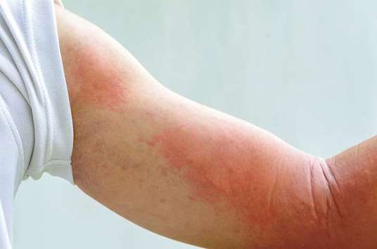 Symptoms of an allergic reaction to an insect bite can include rash and swelling.