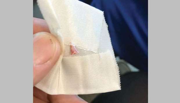 A sharku2019s tooth extracted from the leg of a 13-year-old boy, who was attacked at Atlantique Beach in Islip, New York, is shown in this photo.