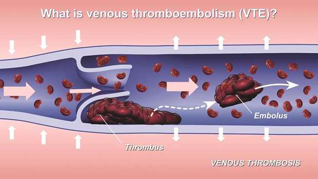 CONNECT: Relationship exists between depression, antidepressant use, and venous thromboembolism (VTE), in which a blood clot forms in the veins of legs or lungs.