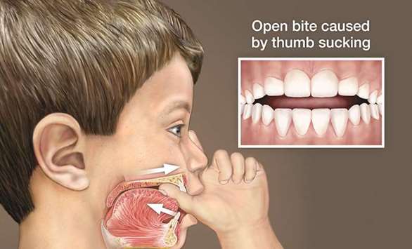 ASSOCIATED RISK: Thumb sucking in children often leads to open bite, treated by Interceptive Orthodonticsu2019 techniques.