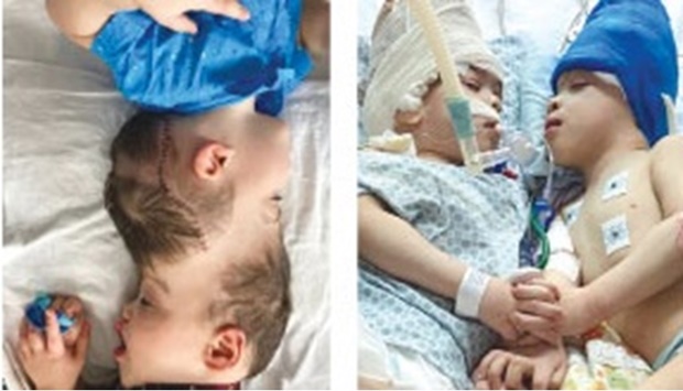 This undated handout photo released by Gemini Untwined shows conjoined twins Bernardo and Arthur Lima before and after their operation at the Instituto Estadual do Cerebro Paulo Niemeyer (IECPN) hospital in Rio de Janeiro.