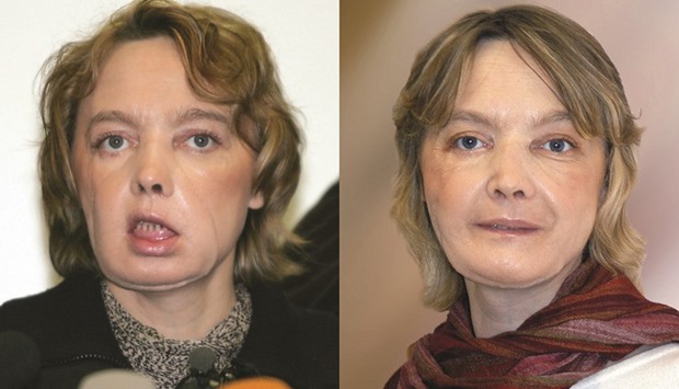 This combination of pictures of Dinoire a few months after her 2005 operation (left, on February 6, 2006) and one year later (in November 2006).