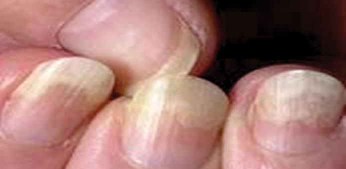 Brittle thin or lifted nails.